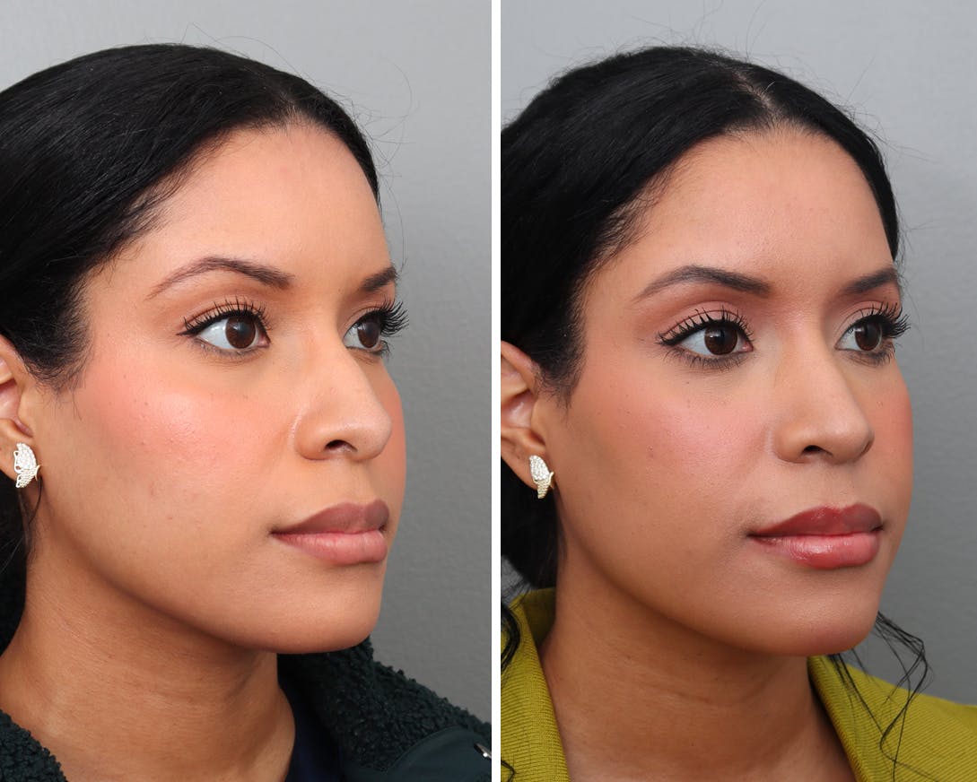 Rhinoplasty Before & After Gallery - Patient 408891 - Image 2