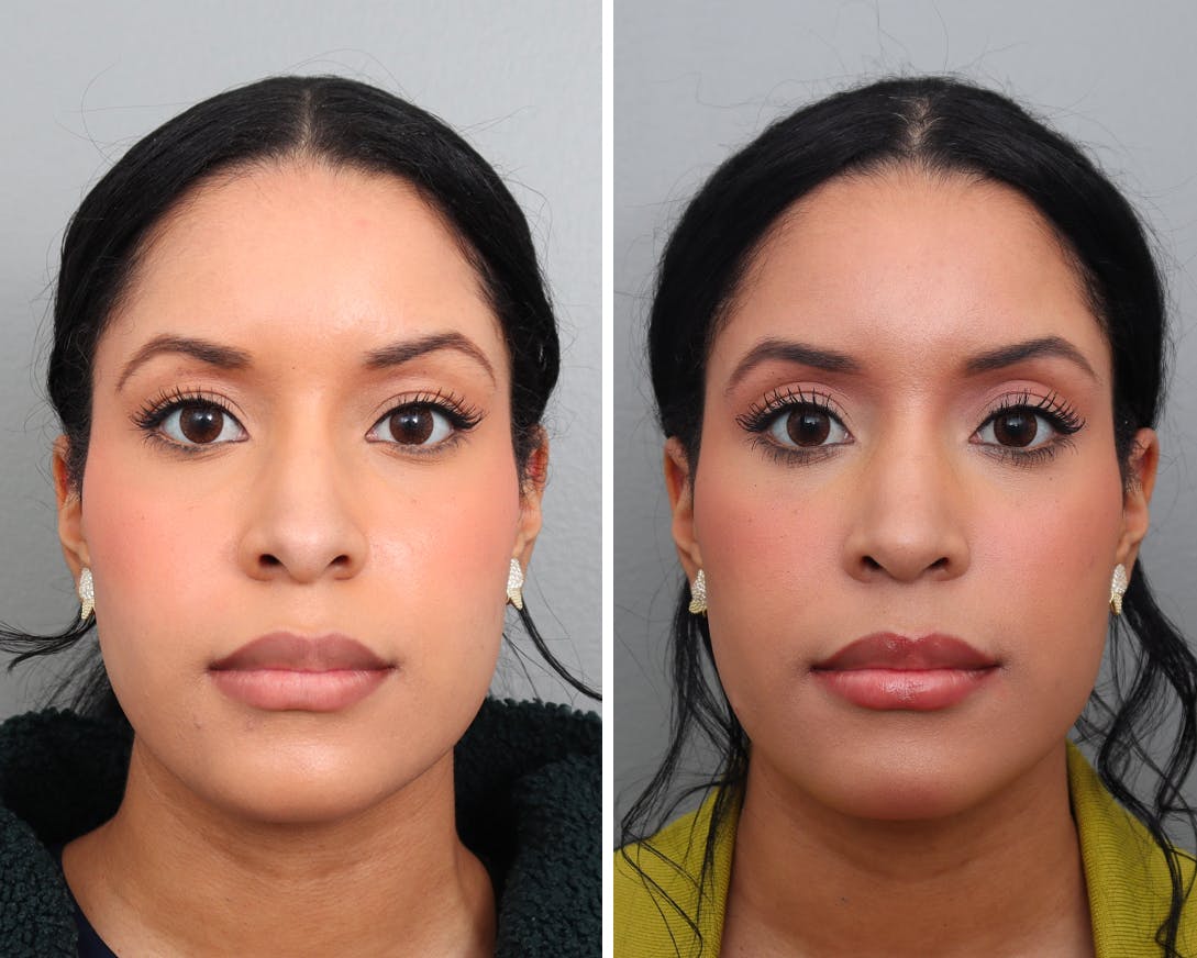 Rhinoplasty Before & After Gallery - Patient 408891 - Image 3