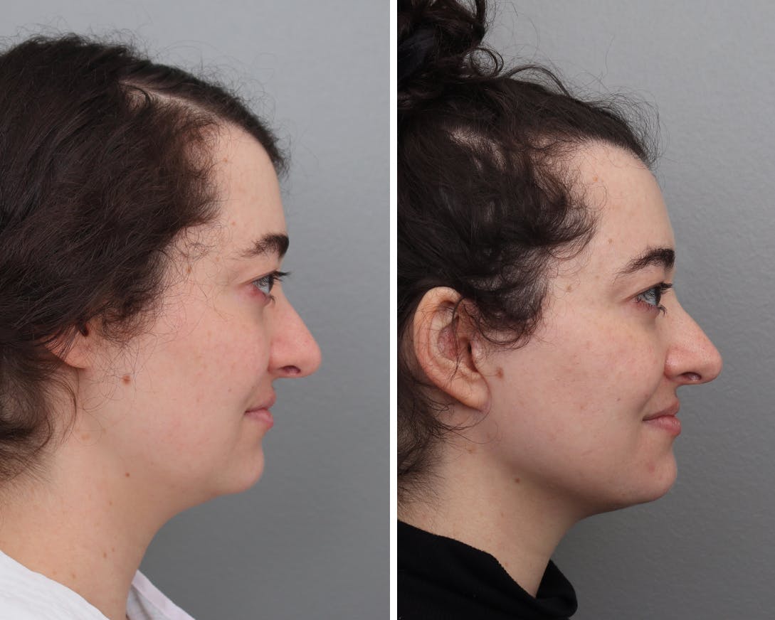 Facelift Before & After Gallery - Patient 174441 - Image 1