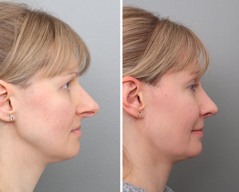 Rhinoplasty Before & After Gallery - Patient 352542 - Image 1