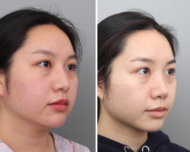 Rhinoplasty Before & After Gallery - Patient 748916 - Image 1