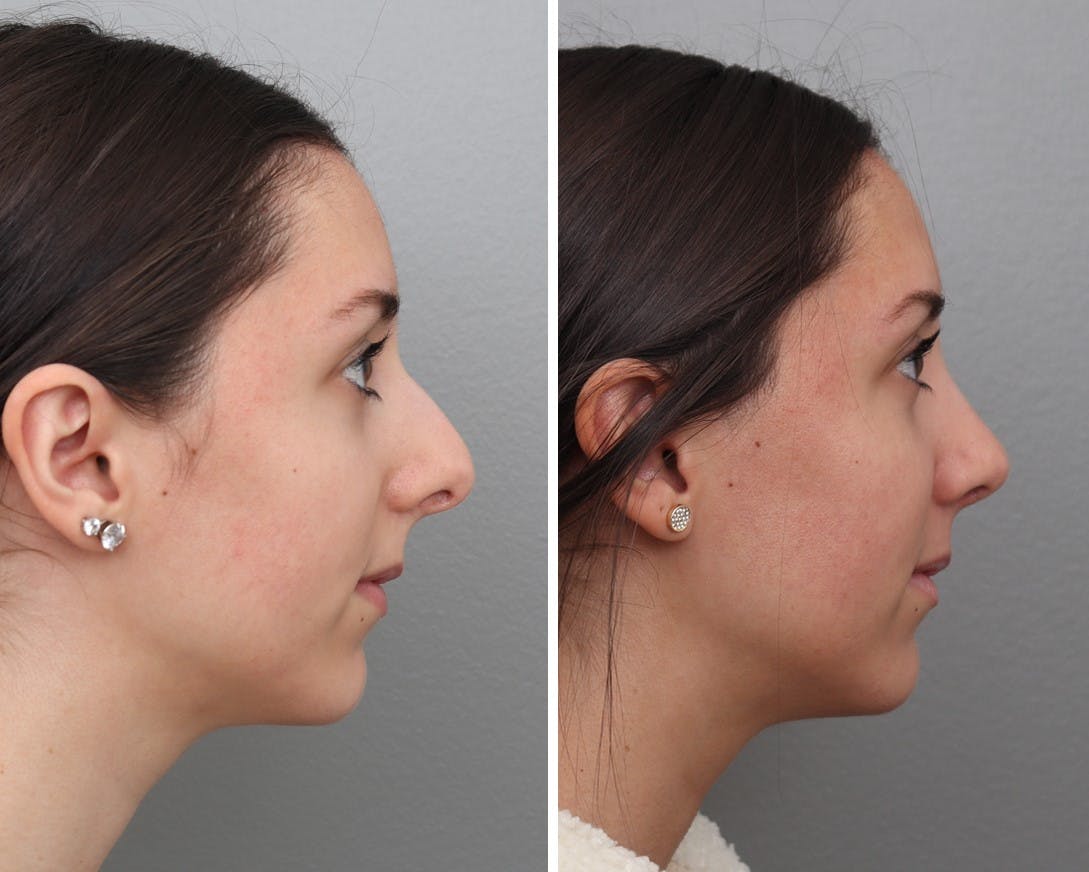 Rhinoplasty Before & After Gallery - Patient 412182 - Image 1