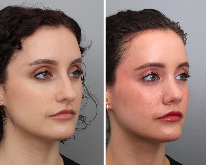 Rhinoplasty Before & After Gallery - Patient 412449 - Image 1