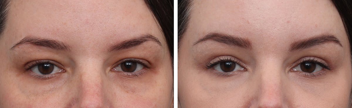 Brow Lift Before & After Gallery - Patient 382008 - Image 1