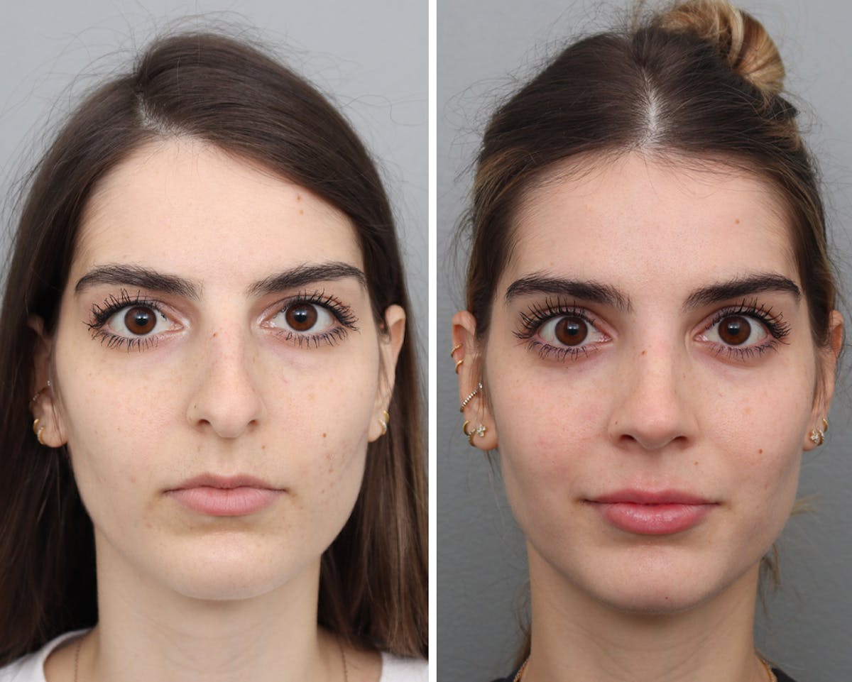 Rhinoplasty Before & After Gallery - Patient 359030 - Image 1