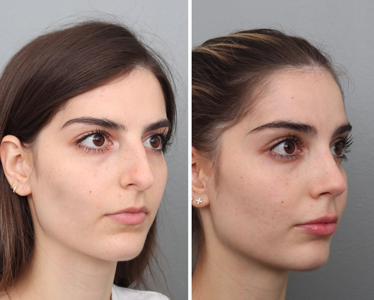 Rhinoplasty Before & After Gallery - Patient 359030 - Image 3
