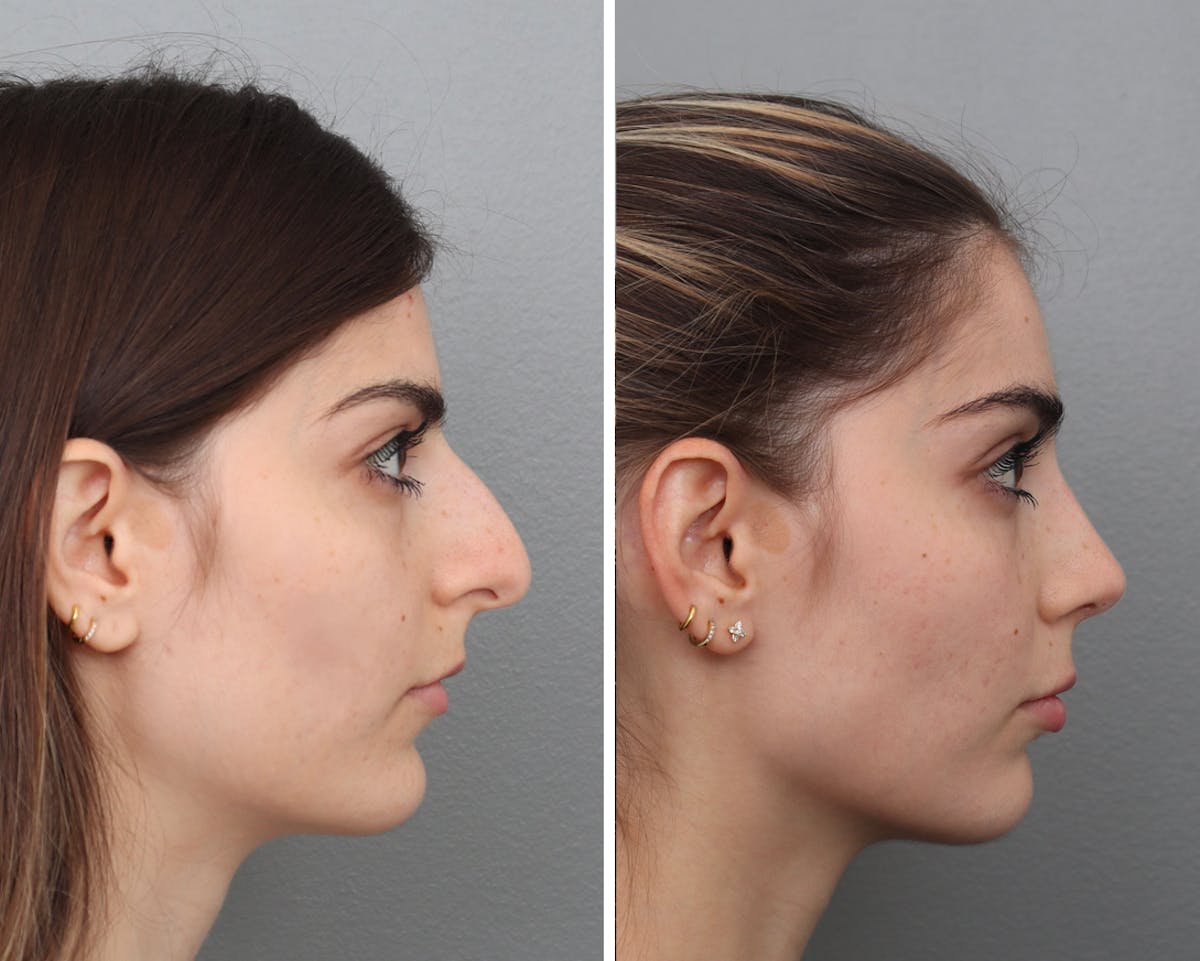 Rhinoplasty Before & After Gallery - Patient 359030 - Image 2