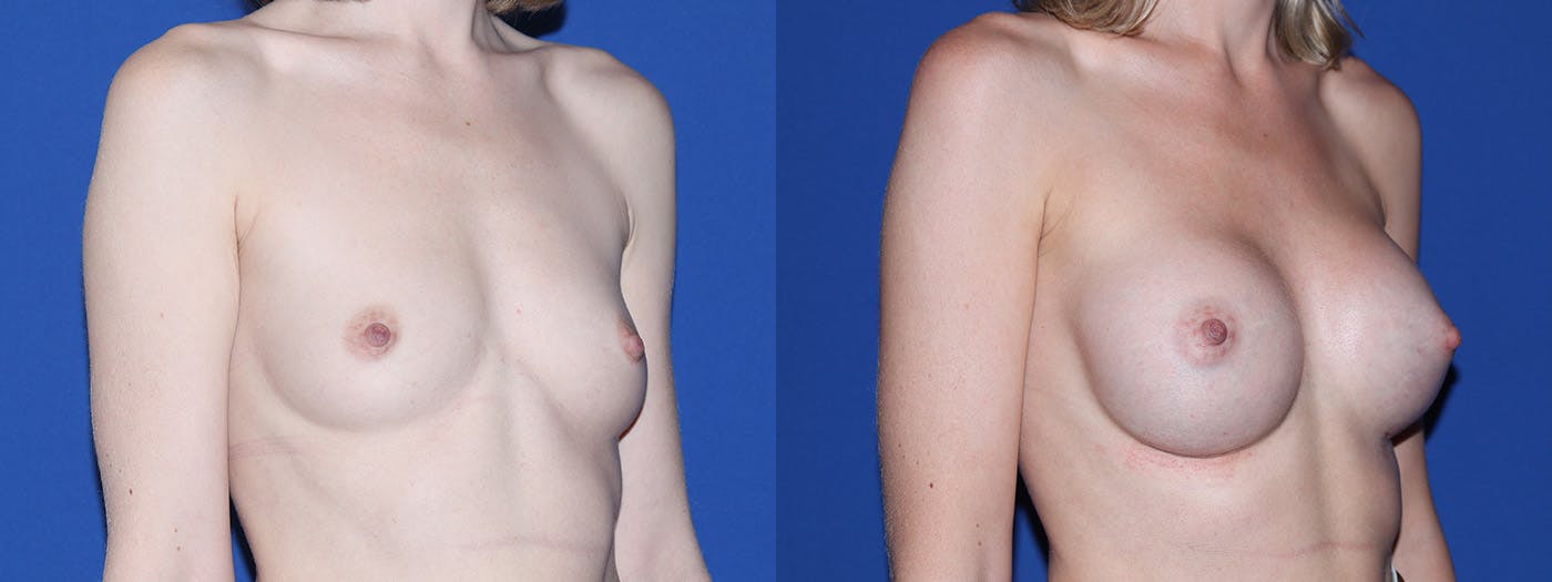 Breast Augmentation Before & After Gallery - Patient 288432 - Image 3