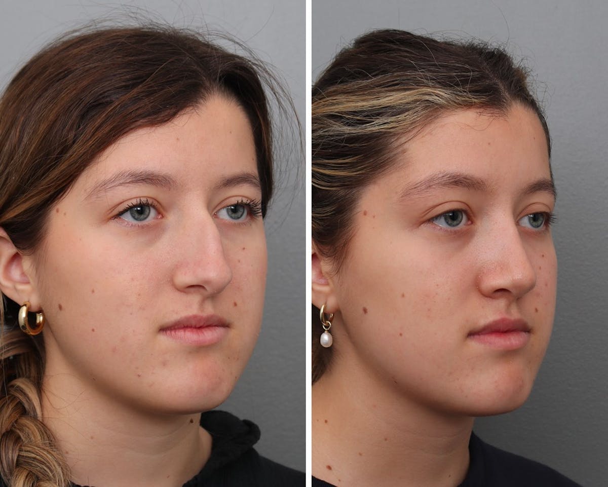 Rhinoplasty Before & After Gallery - Patient 153999 - Image 1