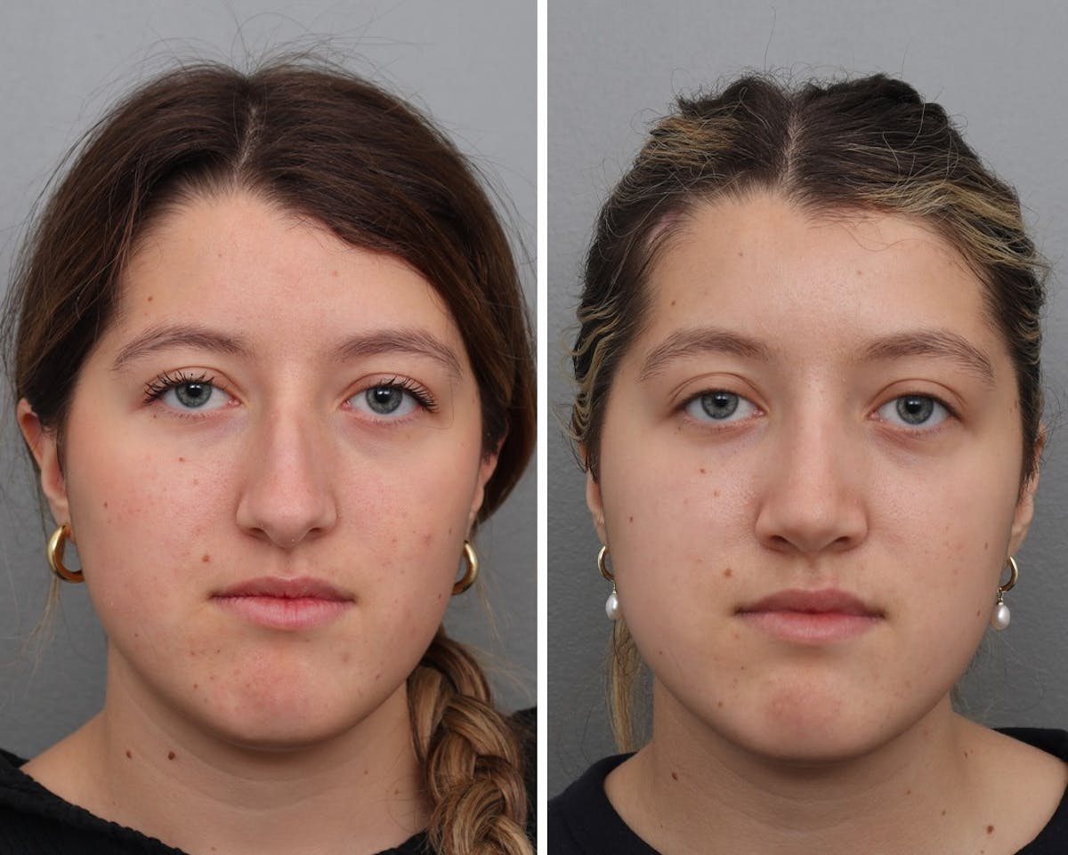 Rhinoplasty Before & After Gallery - Patient 153999 - Image 2