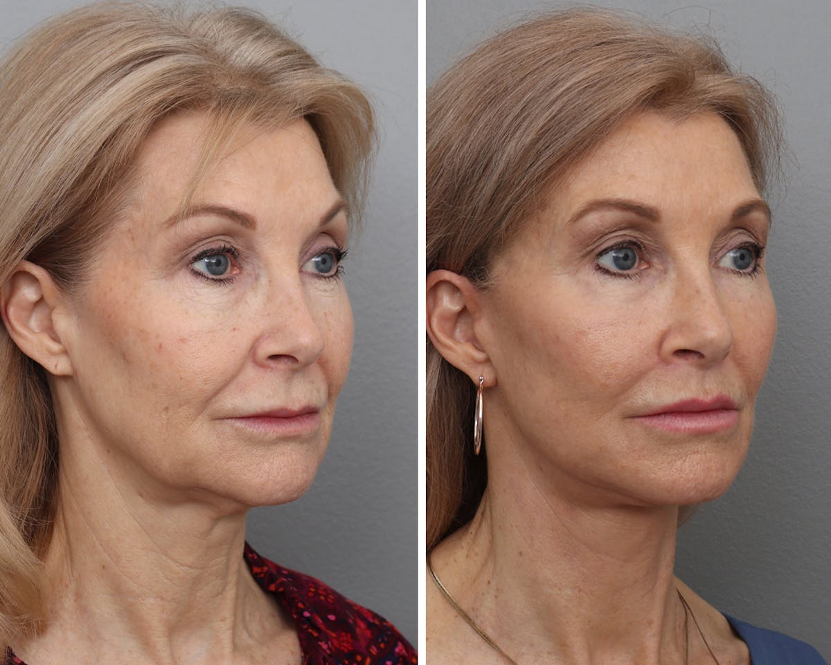 Lip Lift Before & After Gallery - Patient 426243 - Image 1