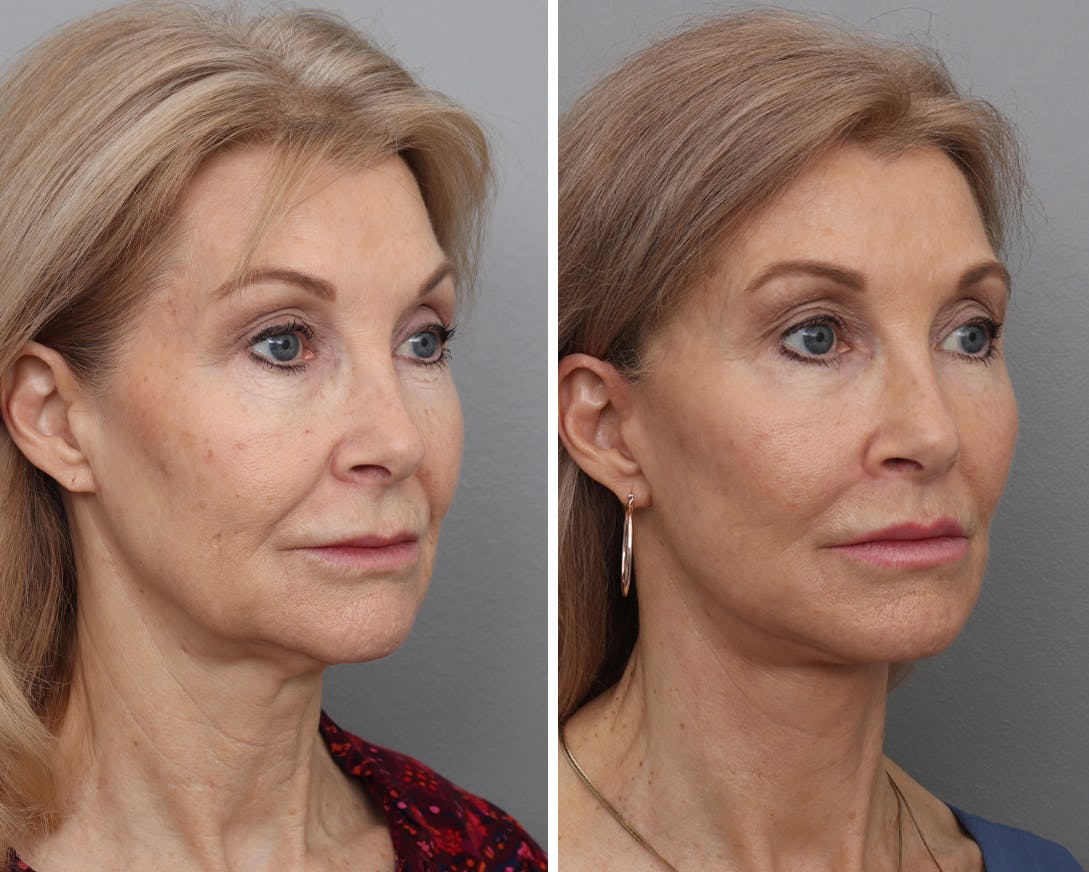 Facelift Before & After Gallery - Patient 210776 - Image 1
