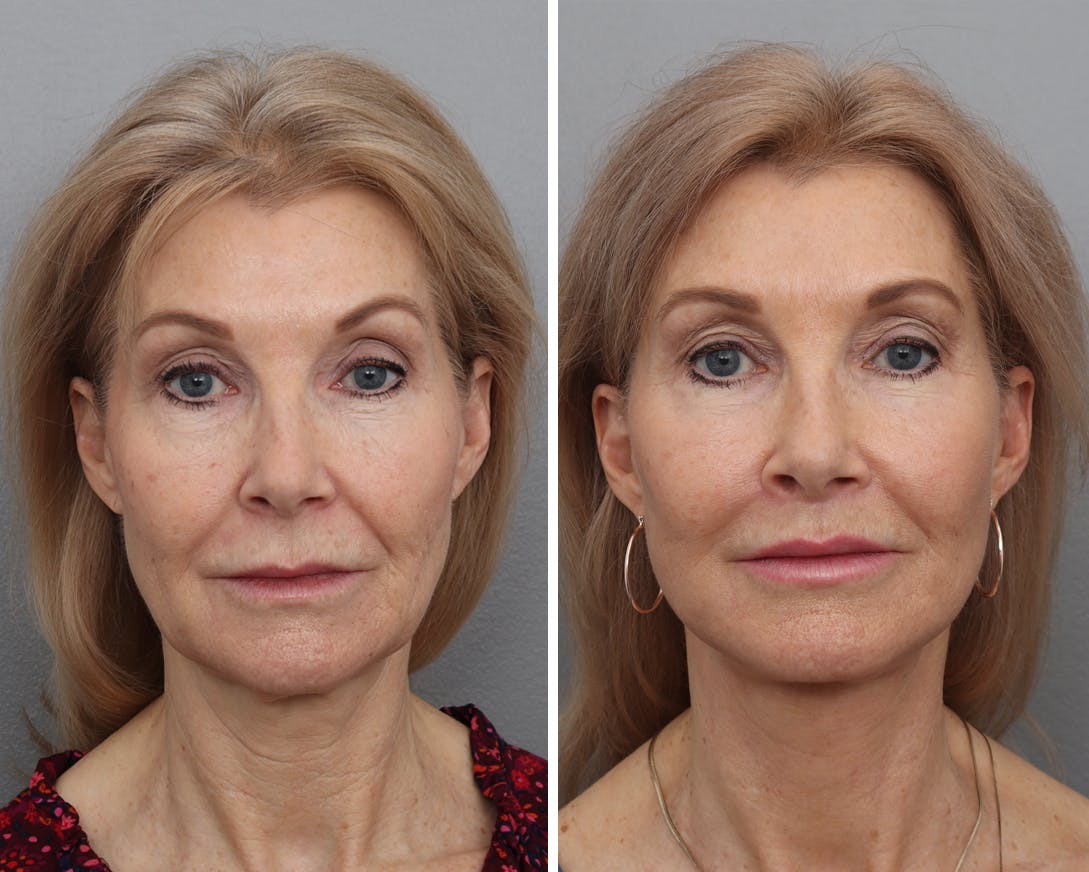 Facelift Before & After Gallery - Patient 210776 - Image 2