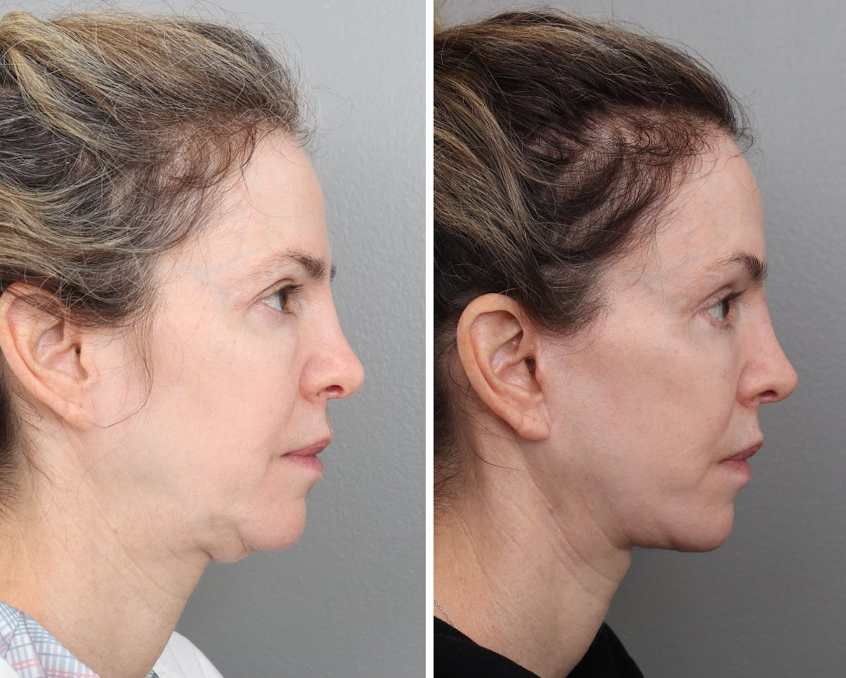 Facelift Before & After Gallery - Patient 201914764 - Image 1
