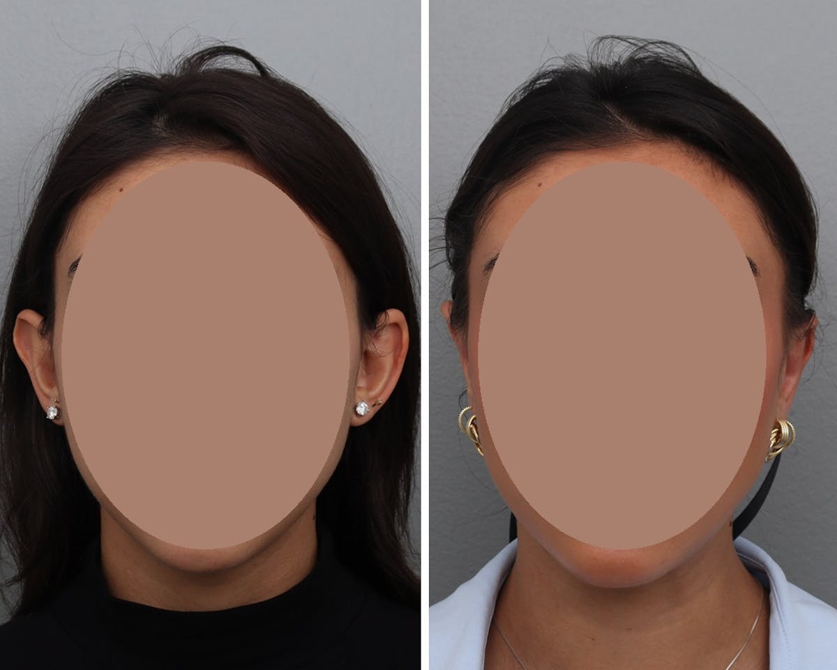 Ear Pinning (Otoplasty) Before & After Gallery - Patient 183555 - Image 1