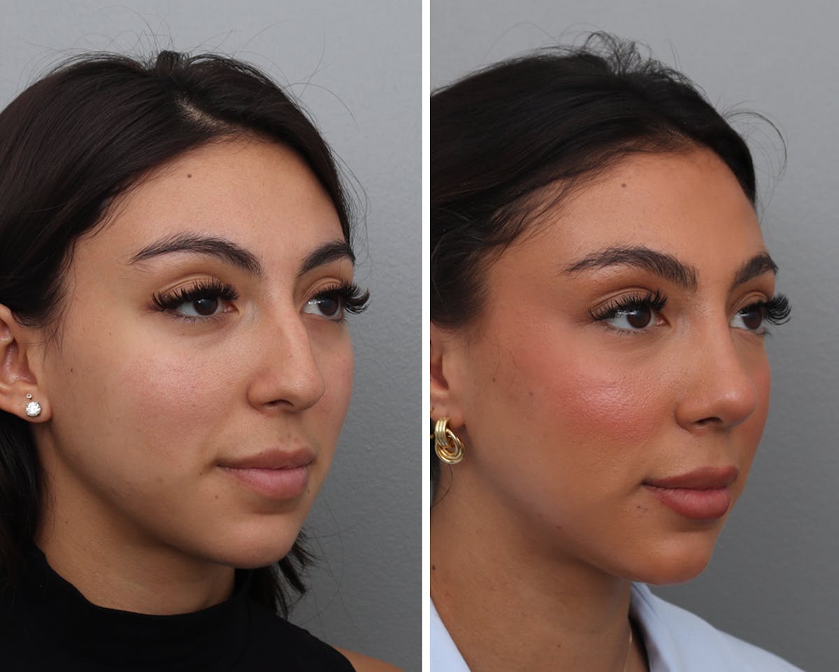 Rhinoplasty Before & After Gallery - Patient 318331 - Image 1