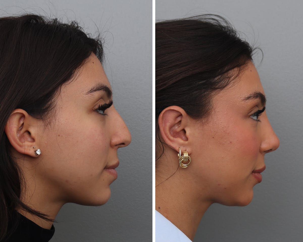 Rhinoplasty Before & After Gallery - Patient 318331 - Image 2