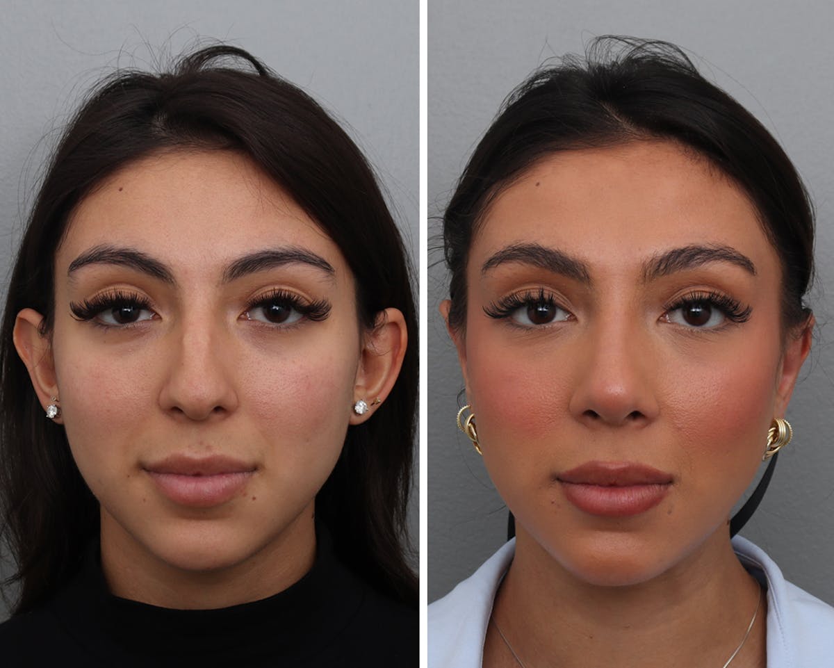 Rhinoplasty Before & After Gallery - Patient 318331 - Image 3