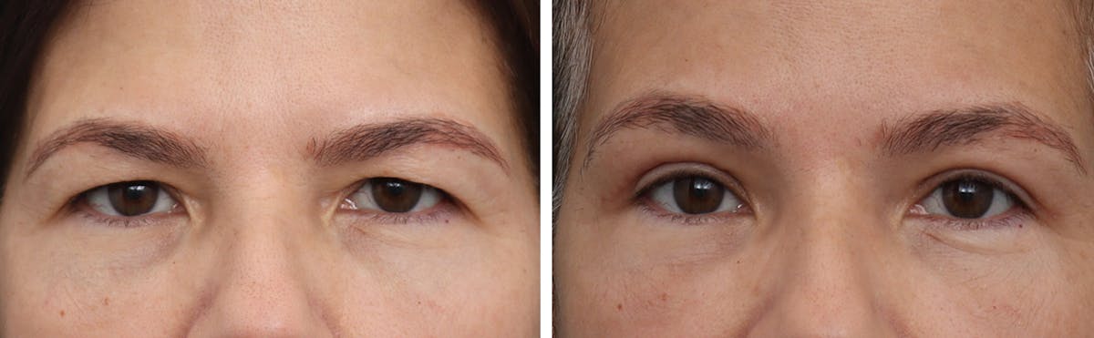 Brow Lift Before & After Gallery - Patient 172030 - Image 1