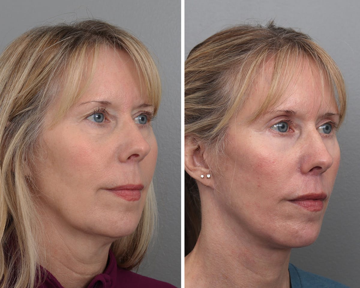 Facelift Before & After Gallery - Patient 396372 - Image 1