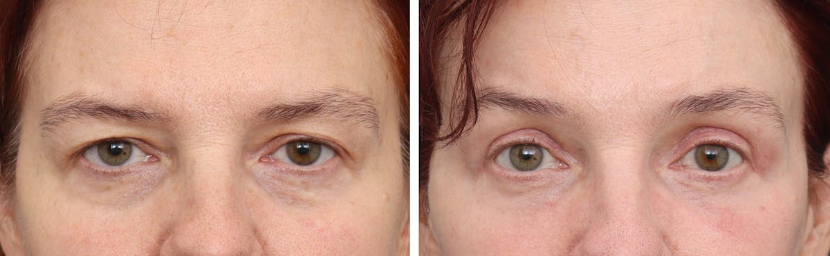 Brow Lift Before & After Gallery - Patient 336711 - Image 1