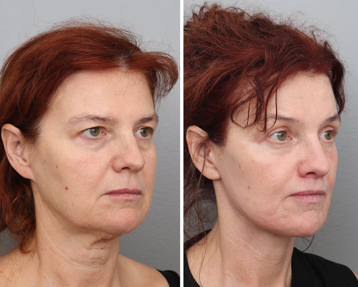 Facelift Before & After Gallery - Patient 175836 - Image 1