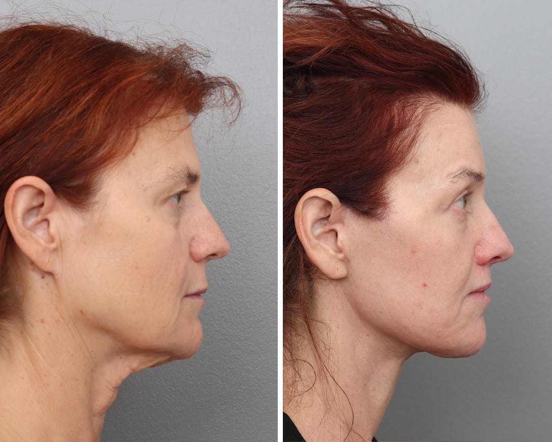 Facelift Before & After Gallery - Patient 175836 - Image 2