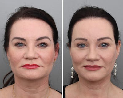 Facelift Before & After Gallery - Patient 338599 - Image 1