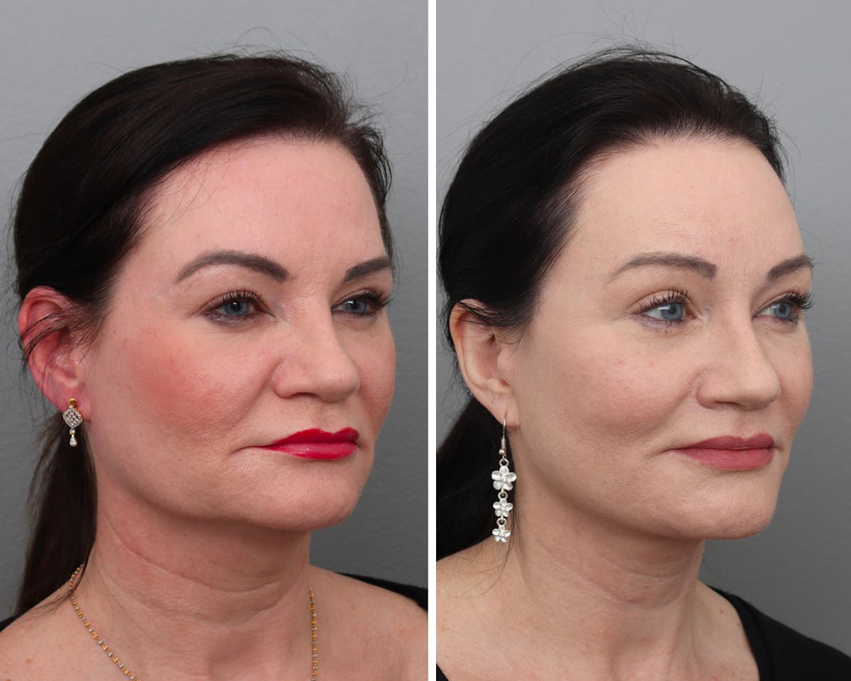Facelift Before & After Gallery - Patient 338599 - Image 2