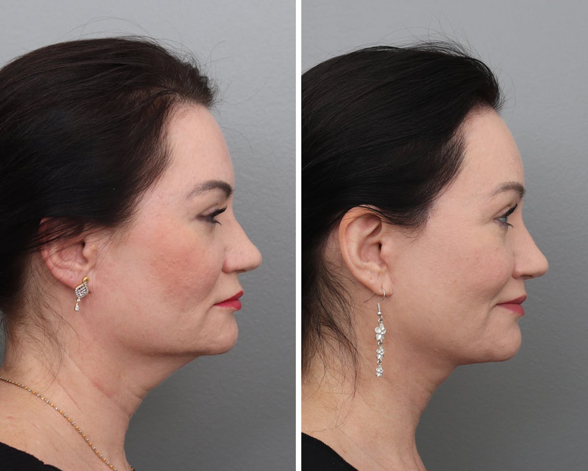 Facelift Before & After Gallery - Patient 338599 - Image 3