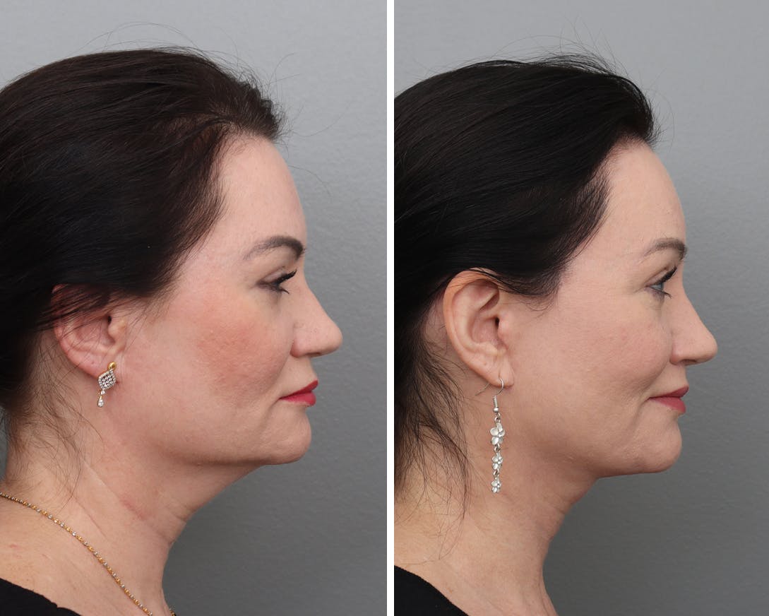 Facelift Before & After Gallery - Patient 338599 - Image 3