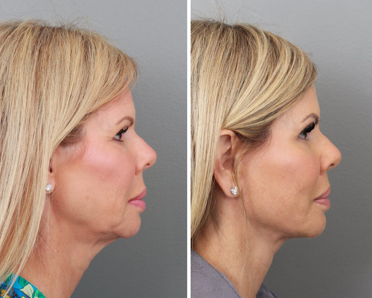 Facelift Before & After Gallery - Patient 64081058 - Image 1