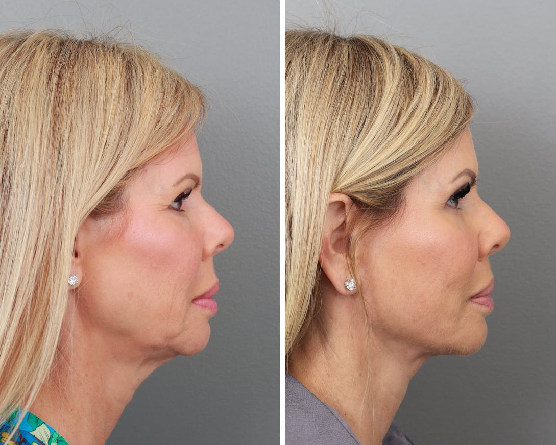 Facelift Before & After Gallery - Patient 64081058 - Image 1