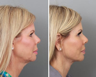 Facelift Before & After Gallery - Patient 64081058 - Image 1