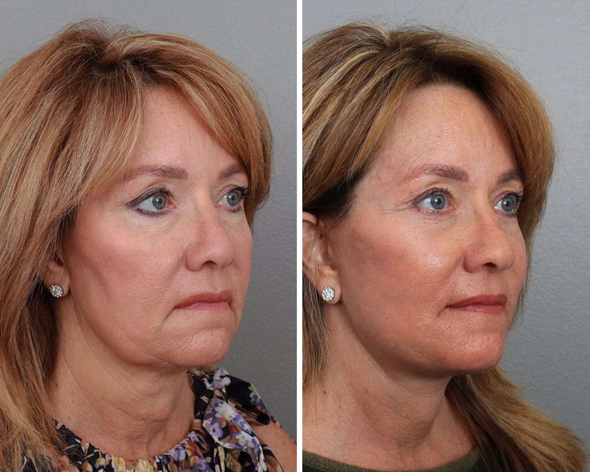Facelift Before & After Gallery - Patient 64081030 - Image 1