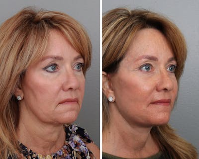 Facelift Before & After Gallery - Patient 64081030 - Image 1