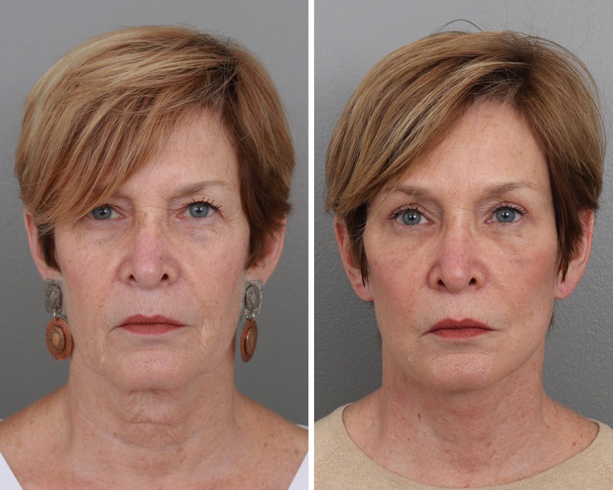 Facelift Before & After Gallery - Patient 64081025 - Image 1
