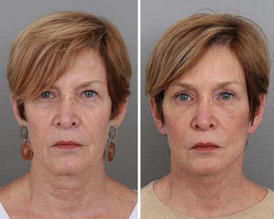 Facelift Before & After Gallery - Patient 64081025 - Image 1