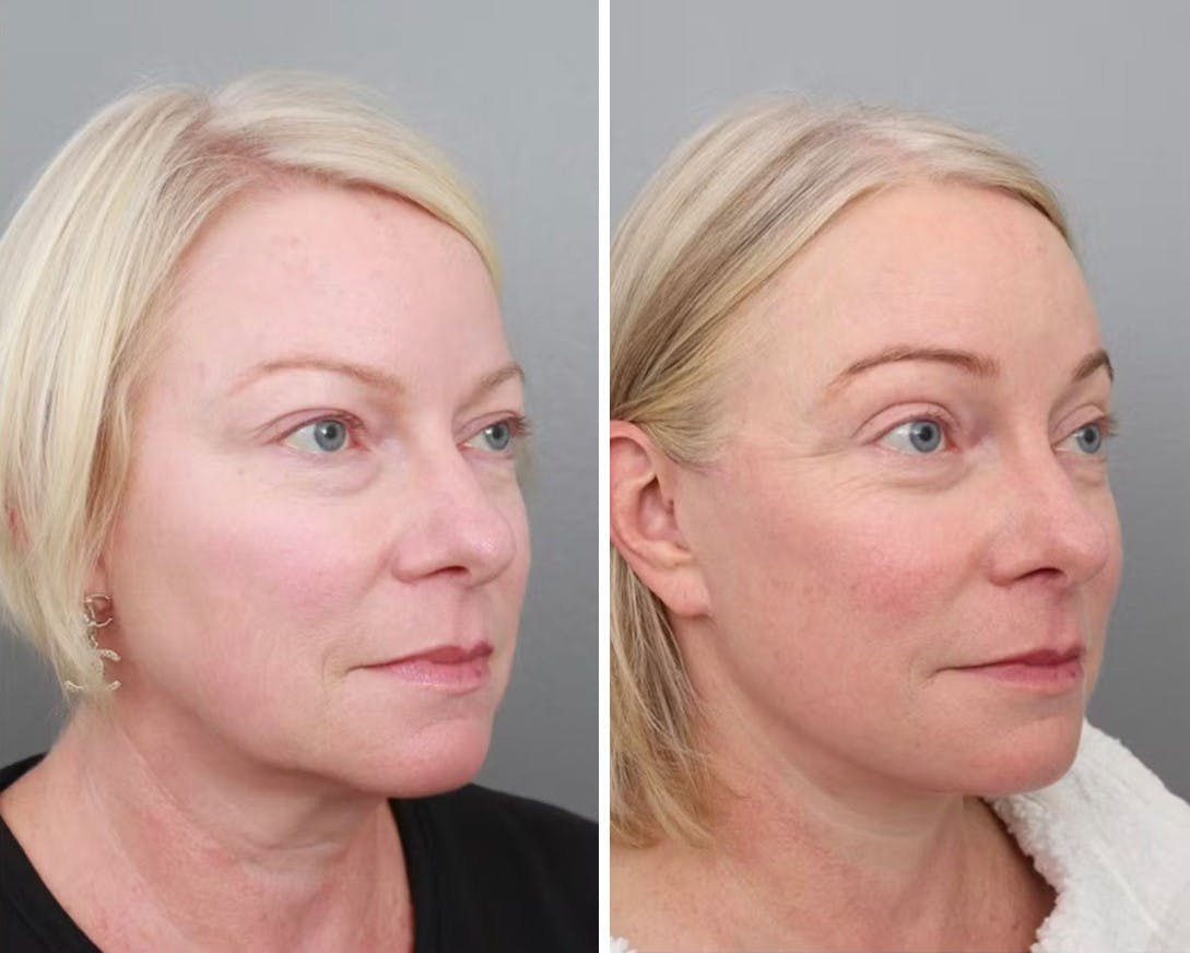 Facelift Before & After Gallery - Patient 70298857 - Image 1