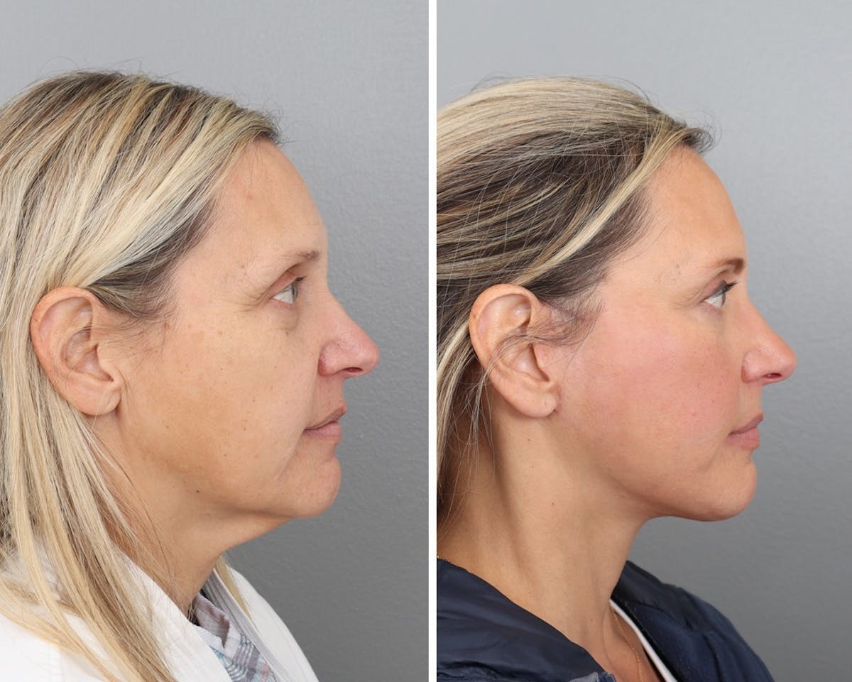 Facelift Before & After Gallery - Patient 64081022 - Image 1