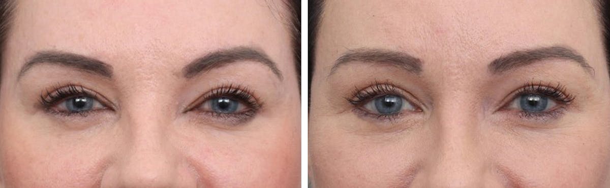 Brow Lift Before & After Gallery - Patient 599309 - Image 1
