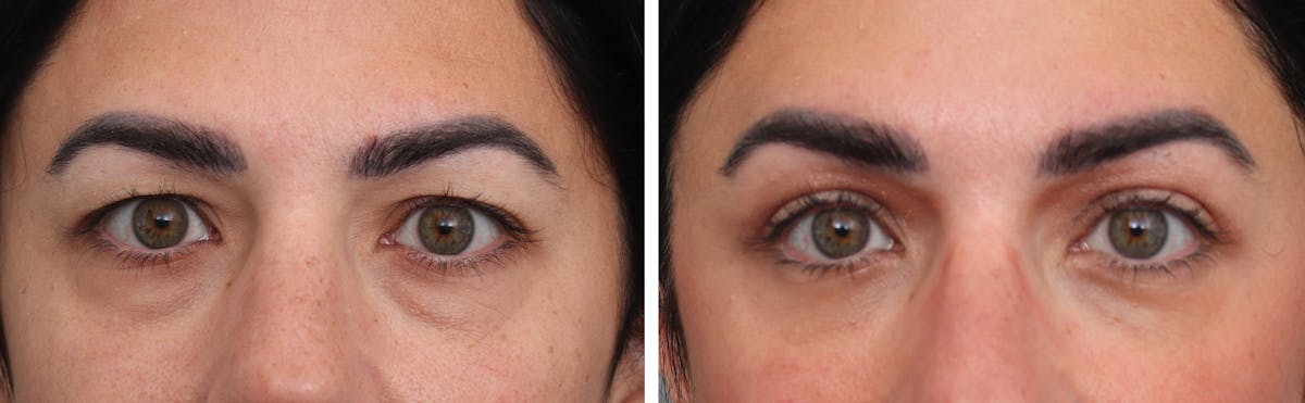 Brow Lift Before & After Gallery - Patient 154332 - Image 1