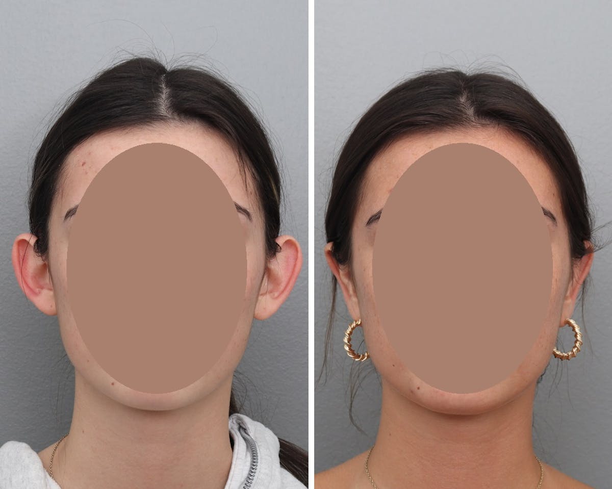 Ear Pinning (Otoplasty) Before & After Gallery - Patient 131250 - Image 1