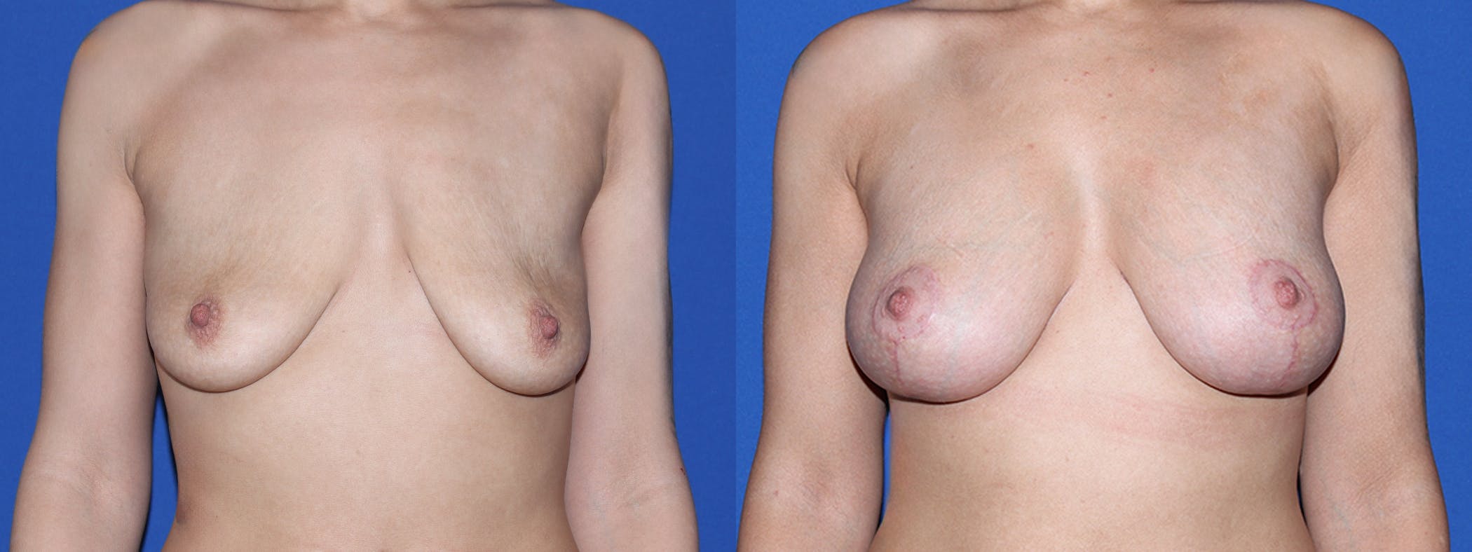 Breast Lift with Implants Before & After Gallery - Patient 144381 - Image 2