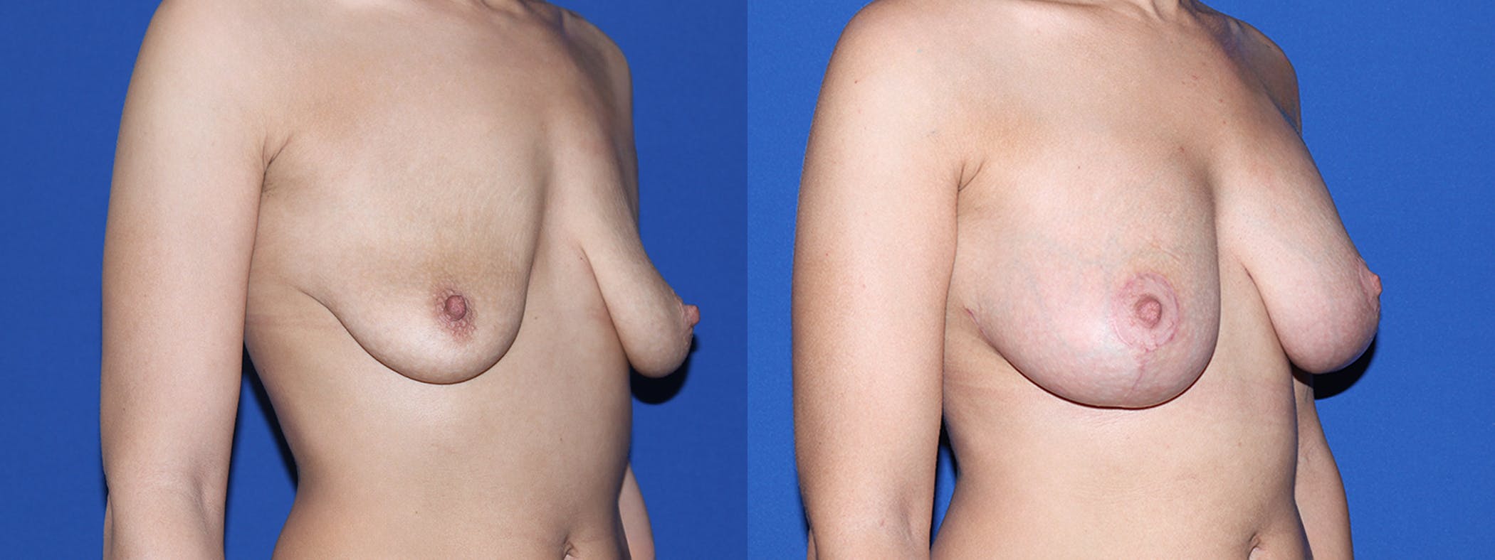 Breast Lift with Implants Before & After Gallery - Patient 144381 - Image 3