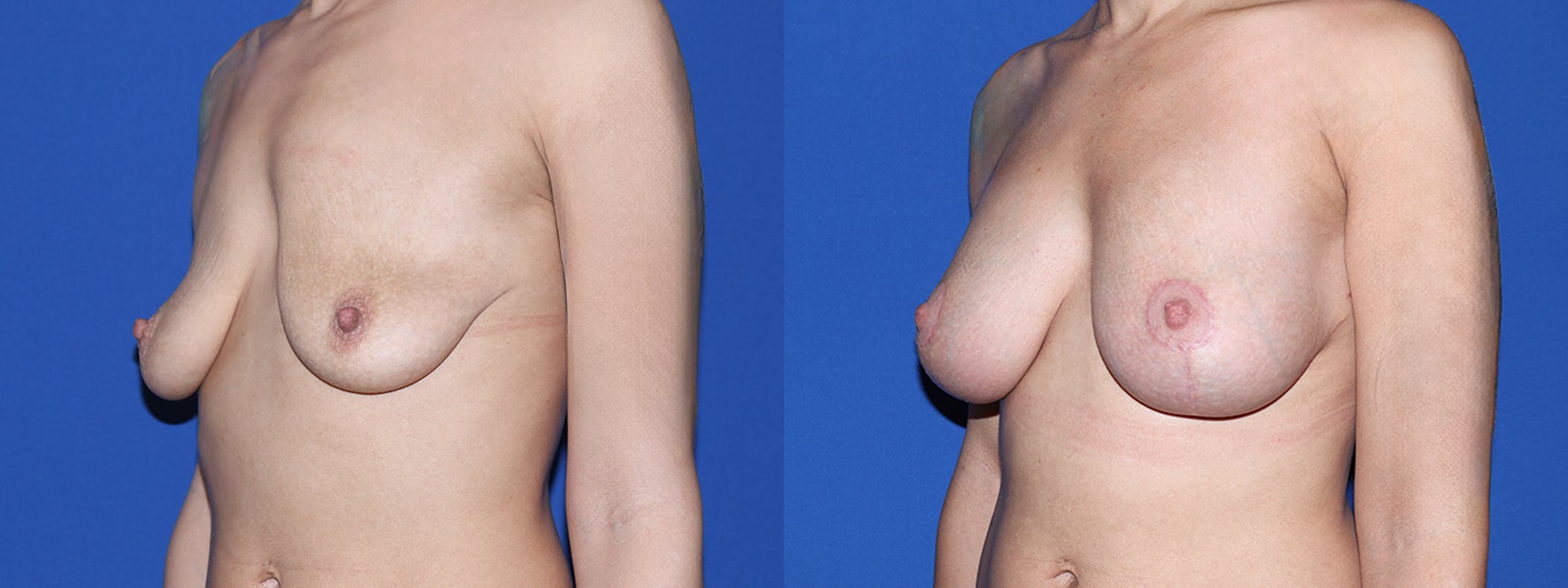 Breast Lift with Implants Before & After Gallery - Patient 144381 - Image 1