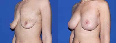 Breast Lift with Implants Before & After Gallery - Patient 144381 - Image 1