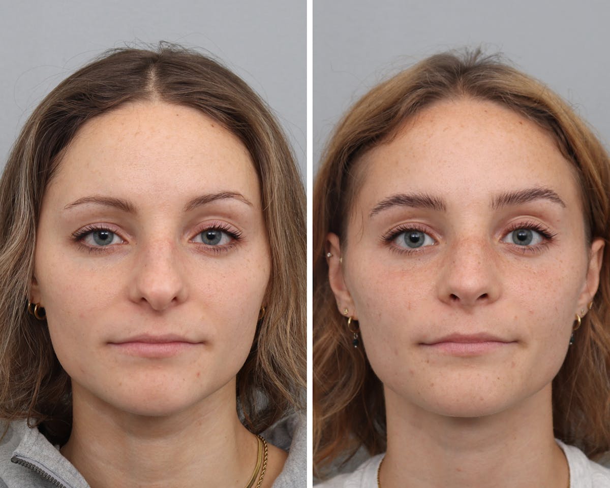 Rhinoplasty Before & After Gallery - Patient 284944 - Image 1