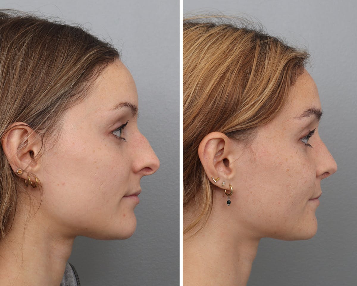 Rhinoplasty Before & After Gallery - Patient 284944 - Image 2