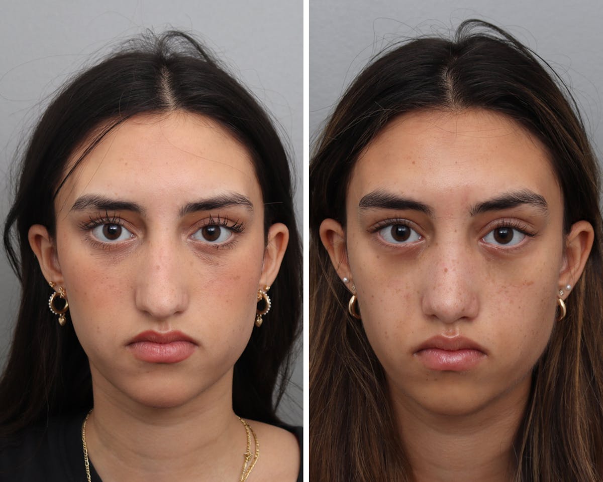 Rhinoplasty Before & After Gallery - Patient 207808 - Image 2